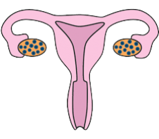 pcos-removebg-preview